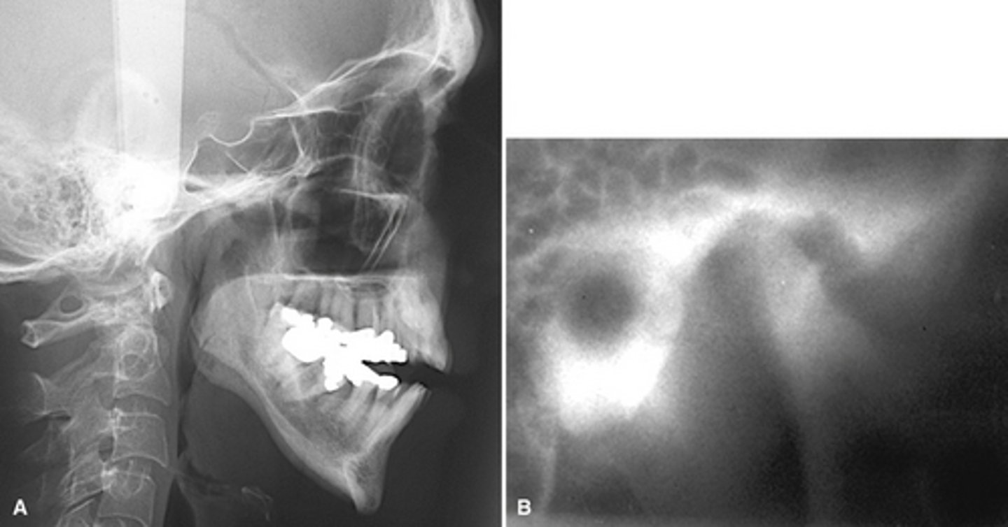<p>What is the diagnosis of the patient based off these radiographs and what are the features?</p>