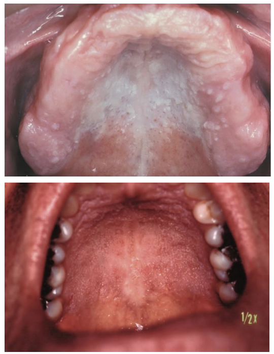 <p>the following are clinical features of what white lesion?</p><p>• White, painless, keratotic papules or plaques, and cobblestoning of the oral mucosa</p><p>• 1/3 parotid or submandibular swelling</p><p>• Erythematous, papules on the skin of the trunk and the scalp</p>