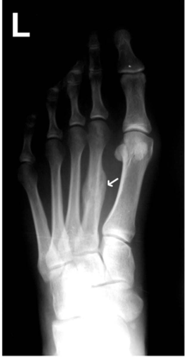 <p>Pain, tenderness, swelling, loss of function, deformity of the affected part, abnormal mobility</p><p>Types of deformities (long bones)</p><p>- Angulation</p><p>- Shortening</p><p>- Rotation</p><p>X-ray confirms diagnosis, directs treatment</p><p>Treatment:</p><p>1. reduction</p><p>2. immobilization</p><p>3. preserve/restore function</p>