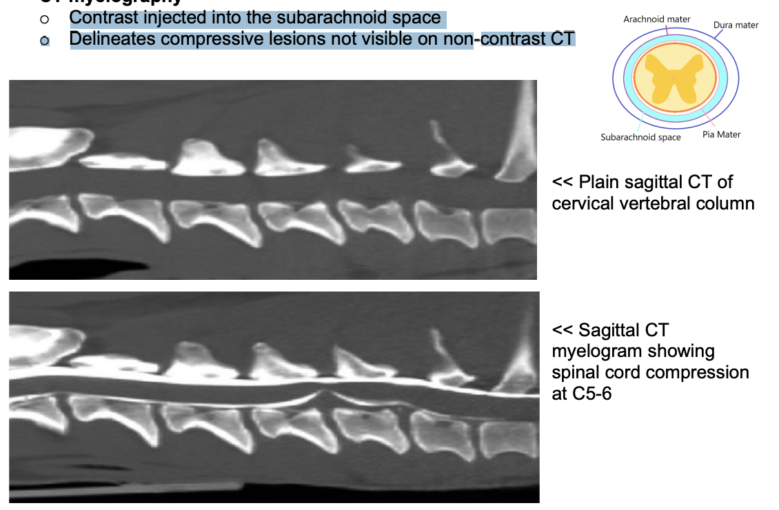 <p>Contrast injected into the subarachnoid space o Delineates compressive lesions not visible on non-contrast CTs</p>