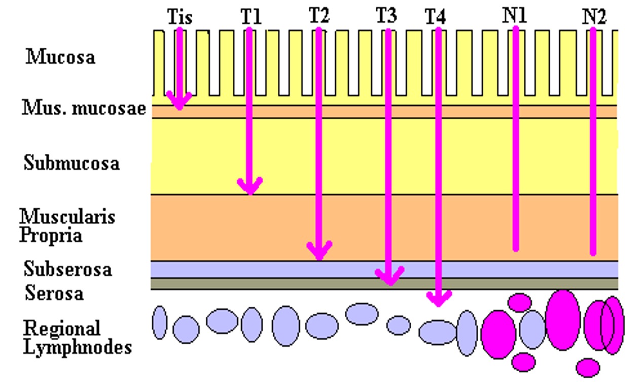 <ul><li><p>Tis - carcinoma in situ </p></li><li><p>T1 - submucosa </p></li><li><p>T2 - muscular is propria</p></li><li><p>T3 - sub serosa</p></li><li><p>T4 - other organs visceral peritoneum </p></li></ul><p></p><ul><li><p>N0 - no nodes </p></li><li><p>N1 - 3 or less</p></li><li><p>N2 - more than 3</p></li><li><p>N3 - nodes on vascular trunk </p></li></ul><p></p>