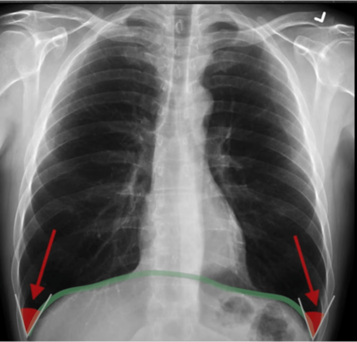 <p>-dome shaped</p><p>-sharp costphrenic angles on both sides</p><p>-right diaphragm should be higher</p>