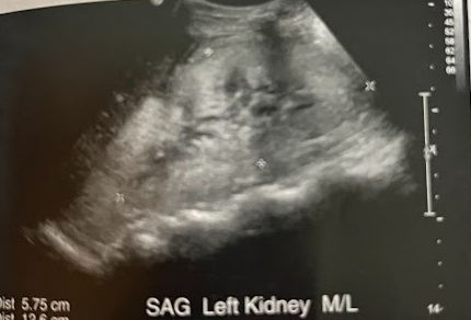 <p>A 50 year old man is sent from the ED for a renal sonogram. He c/o not feeling well and says his hands and feet are swollen and urine was smoky-colored. He recently was treated for strep throat. Vital signs are normal w/a blood pressure of 150/110mmhg. The renal sonogram reveals prominent pyramids w/an increase in the cortical echogenicity. What is the likely diagnosis for this pt?</p>