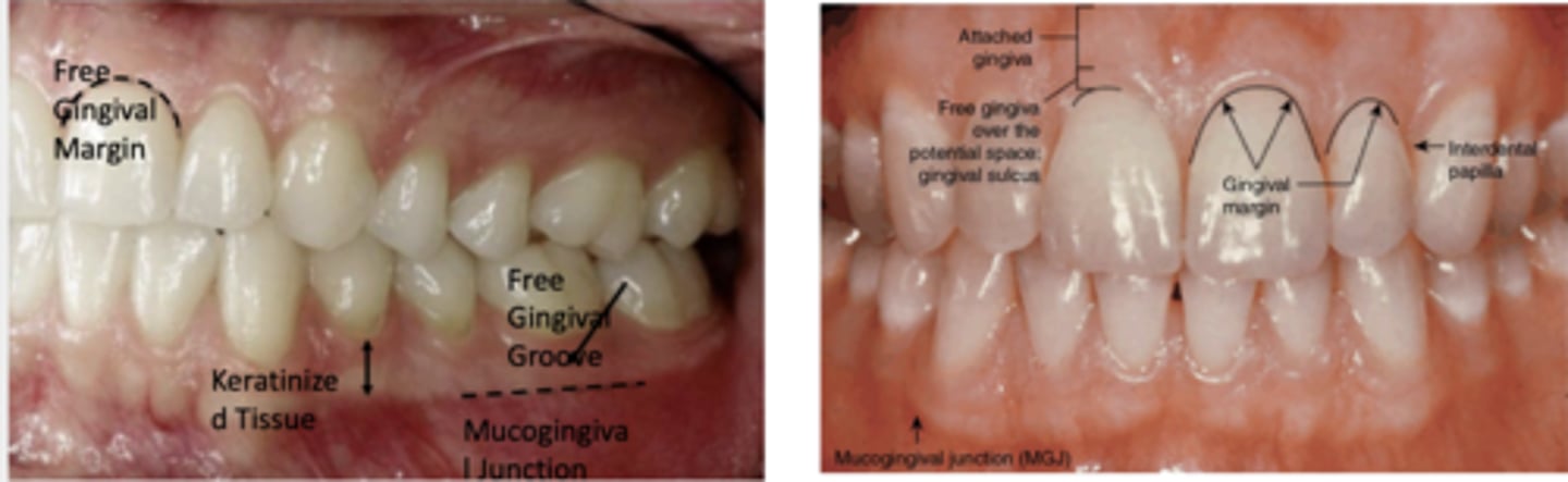 <p>Free gingiva, interdental gingiva (interdental papilla) and attached gingiva</p>