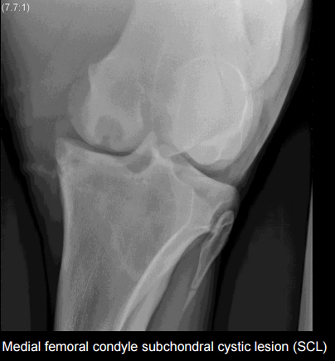 <p>Bone cysts</p><p>Articular or nonarticular</p><p>May not always produce lameness</p><p>TX: Normal bone remodeling, intraarticular meds</p><p>Usually in horses &lt;3 y.o.</p><p>Most common sites= stifle, pastern, coffin, elbow</p>