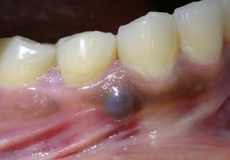 <p>What is a gingival cyst?</p>