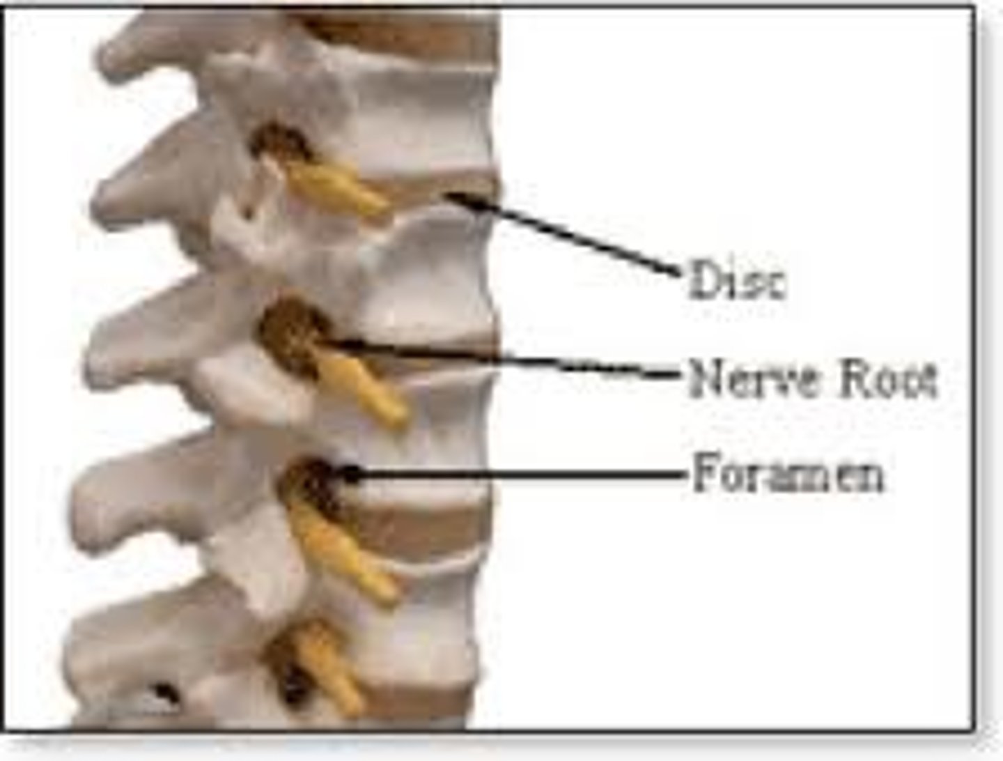 <p>spinal nerve root, radicle</p>