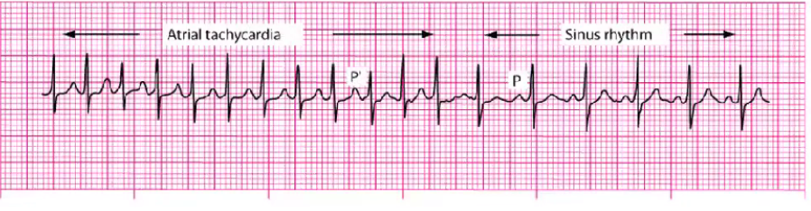 <p>O2, IV access</p><p>Vagal maneuvers (things to slow HR down - ice around face, bear down, breathe thru a straw)</p><p>Anti-arrhythmic (adenosine) (given QUICKLY over SECONDS, stop caulk and flush immediately - stuns heart asystole into sinus), can give twice 6 mg to 12 mg</p><p>Ca Channel Blockers, Amiodarone, BBs</p><p>Cardioversion (synchronized shock to sync heartbeat) - avoid R on T phenomenon (Torsades), Sometimes use conscious sedation; TEE done before to look for clots prior to shock, heparin drip as well</p><p>Ablation for chronic (surgery to burn off abnormal pathways)</p>