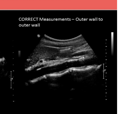 <p>the preferred imaging plane to measure AO AP is </p><p>.</p><p>a) coronal</p><p>b) transverse </p><p>c) sagittal</p><p>d) radial </p>