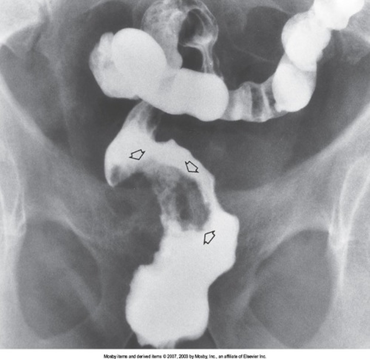 <p>50% of all colon cancers found in what two areas?</p>