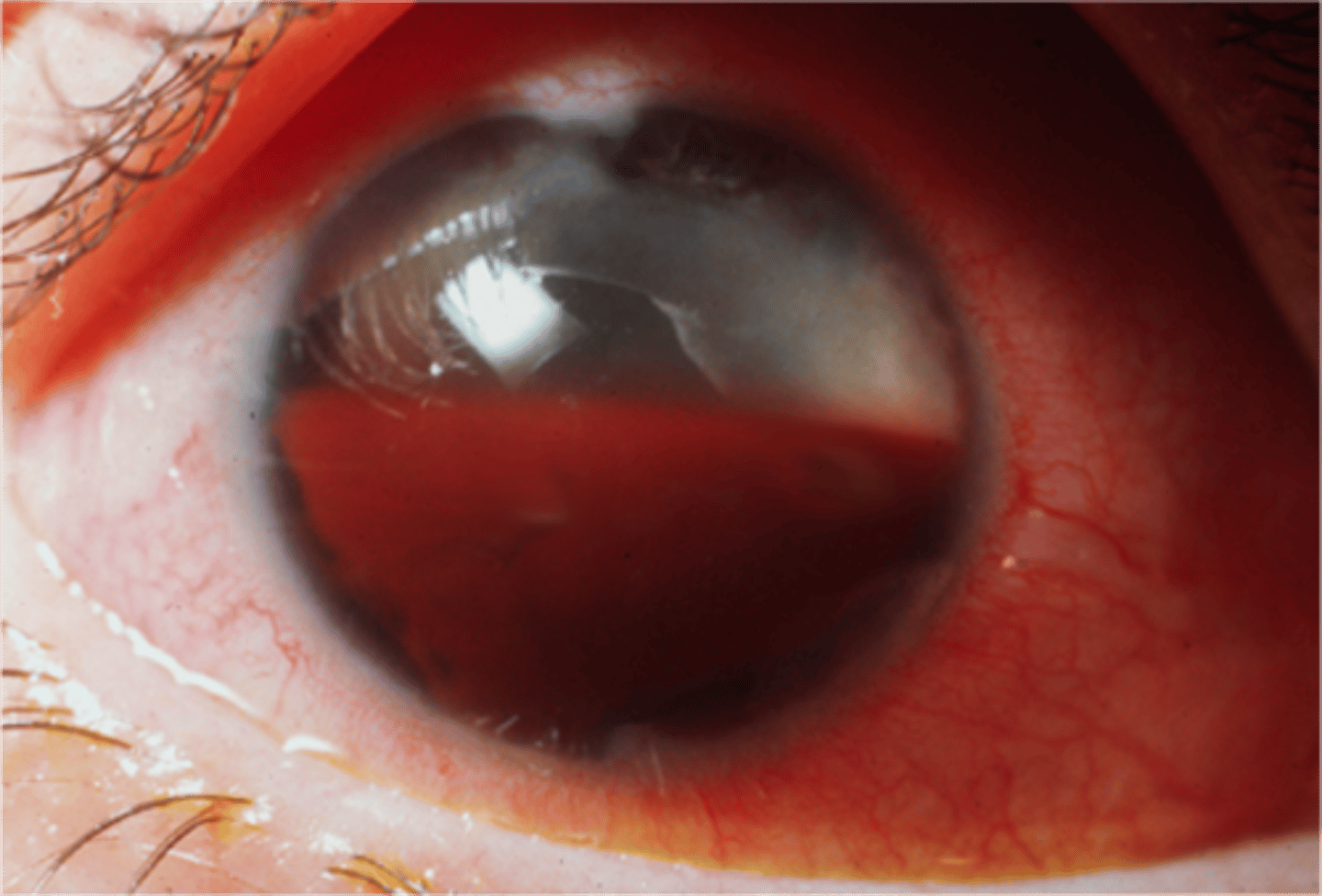<p>Hyphema</p>