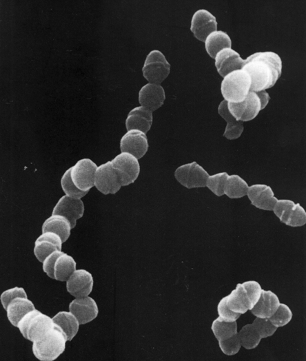 *Streptococcus pneumoniae* Meningitis 