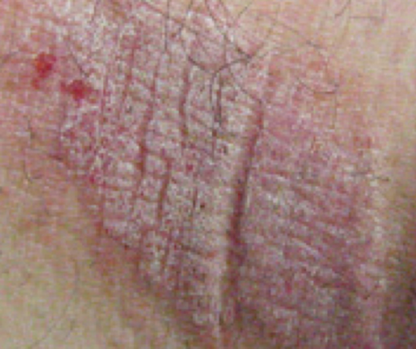 <p>Thickening and roughening of the skin with increased visibility of the normal skin furrows</p><p>Ex: atopic dermatitis</p>