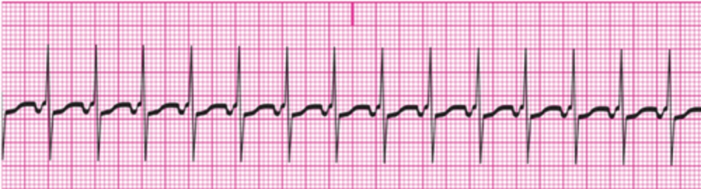 <p>Junctional tachycardia</p>