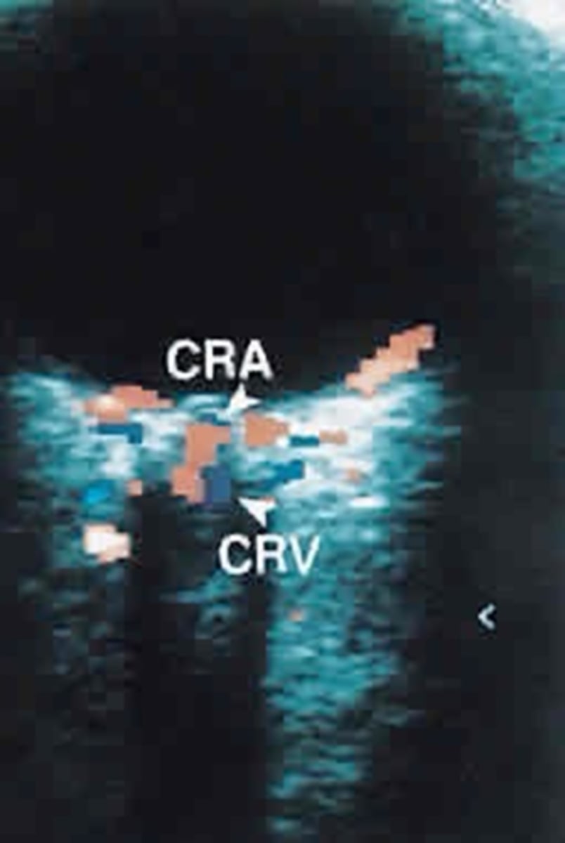 <p>A fundoscopic exam reveals a "blood and thunder" appearance with retinal hemorrhages, edema, dilated retinal veins, and cotton wool spots. Visual acuity may be impaired, and fluorescein angiography can assess nonperfusion of the retina.</p>