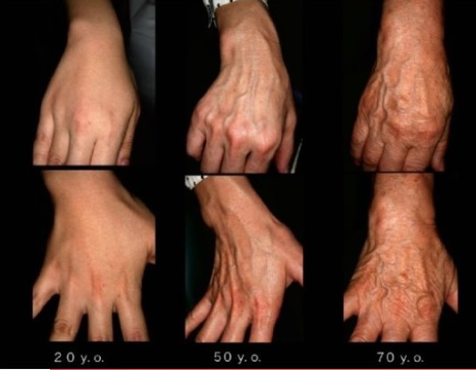 <ul><li><p>begin to fall apart, elastic fibers stiffen and thicken, wrinkling the skin</p></li></ul><p></p>