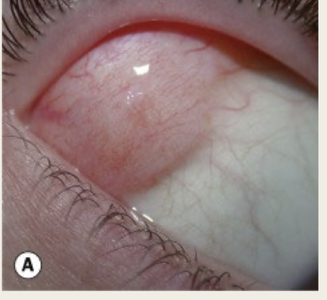 <p>mass of fatty tissue in abnormal position (outer canthus)</p>