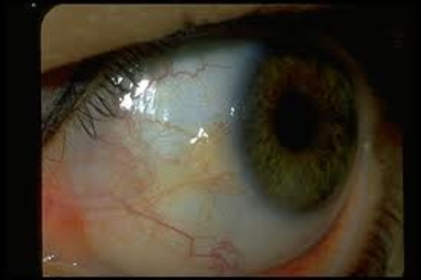 <p>Similar to a Pterygium but doesn't interfere with vision; gritty sensation</p><p>Yellowish, raised, thickening lateral to the iris (less often medial)</p>