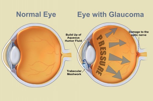 a group of eye conditions that can cause blindness. The visual cortex is affected