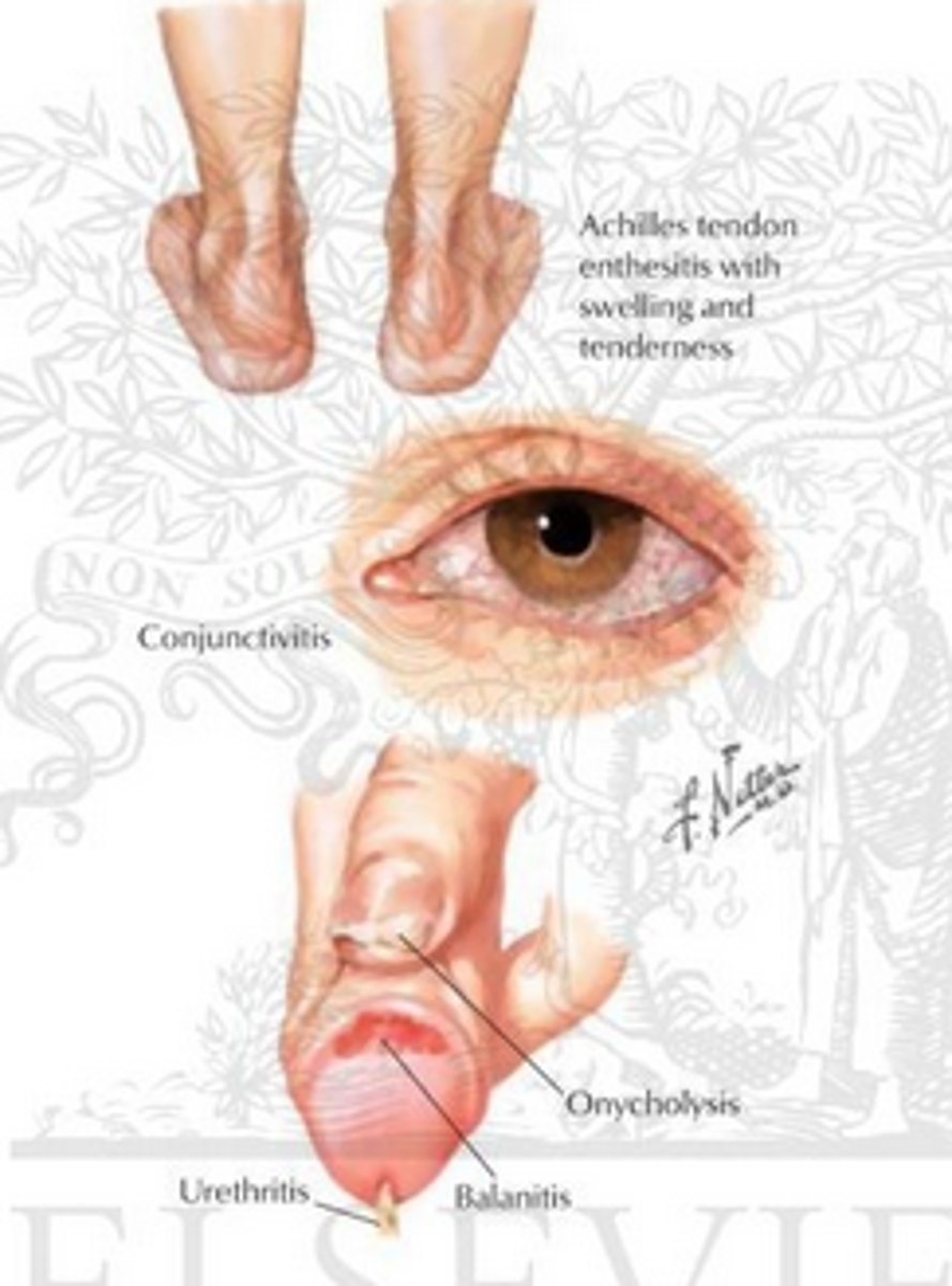 <p>1. Arthritis<br>2. Conjunctivitis <br>3. Urethritis</p>