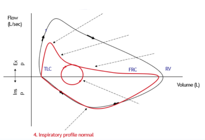 <p>Normal</p><ul><li><p><span>P<sub>pl</sub> is always negative so P<sub>TM </sub>&nbsp;is always +ve during inspiration so loss of elastic recoil has no effect</span></p></li><li><p><span>No issue with airway collapse during inspiration</span></p></li></ul>