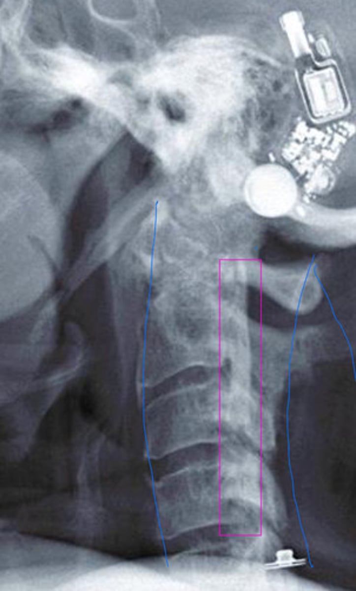 <p>What is the pink?</p><p>What happened to there spinous processes?</p>