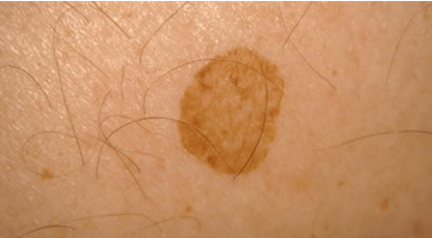 <p>A flat, non-palpable lesion measuring &lt; 1 cm.</p><p>- Ex: freckles, flat moles</p>