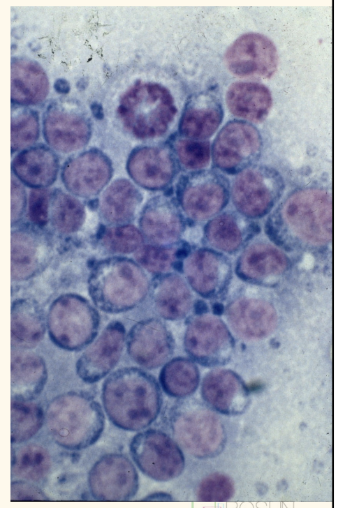 <p>• FNA diagnostic in 90% of dogs • Dogs generally have diffuse, lymphoblastic lymphoma • Use needle only technique or minimal suction (fragile cell) • Don’t apply too much pressure when smearing • Take samples from <strong>popliteal node</strong> – Avoid submandibular node (often reactive 2dry to dental disease) • Monomorphic population of large lymphoblasts (&gt;50%) – Clumped chromatin, nucleoli – Basophilic cytoplasm – Mitoses • (Remember thymoma)</p>