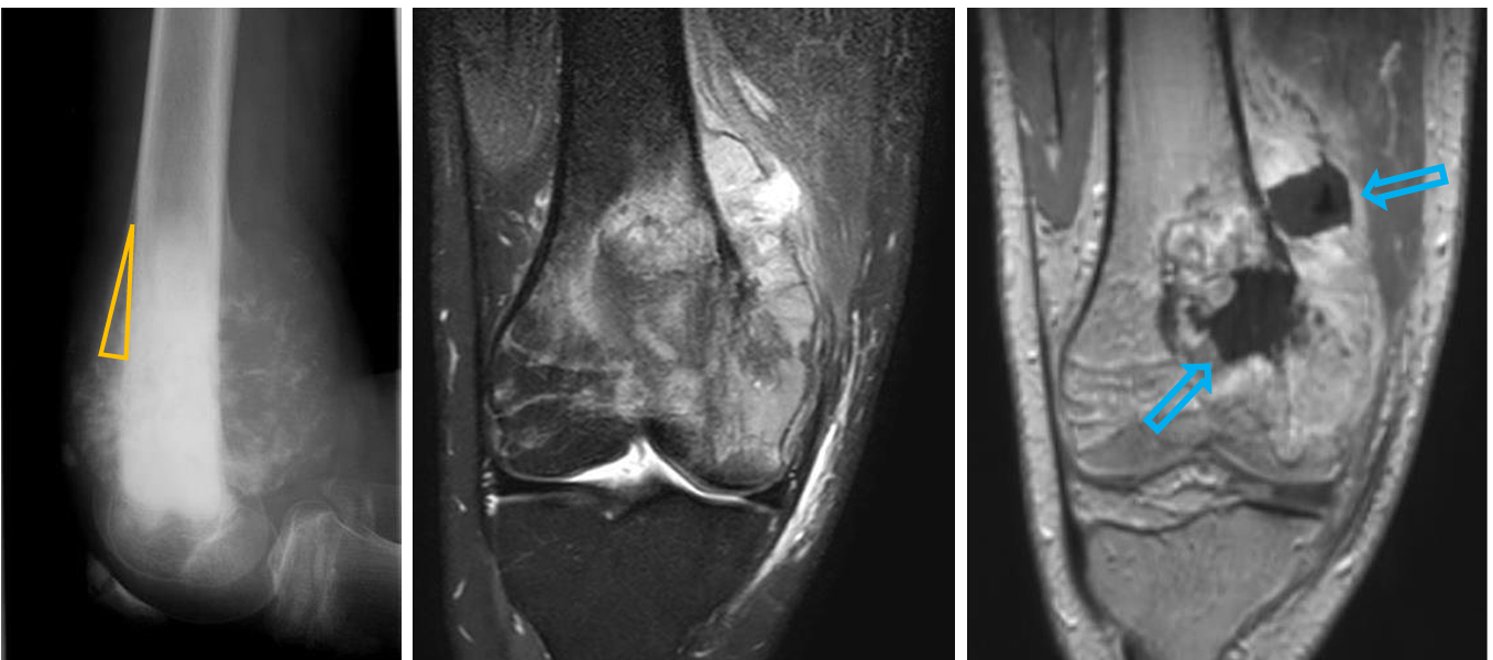 <p>Patient history: soft tissue swelling and pain of the distal femur in a 22-year-old patient </p><p>Modality: X-ray of the left knee (left), PD FS (proton density fatsat) and T1W postcontrast MRI (middle and right, respectively) </p><p>Region: left knee, lateral view (radiograph), coronal views (MRI) </p><p>Radiologic sign: Inhomogeneous destructive metaphyseal lesion of the left femur. Periosteal reaction, Codman triangle (yellow triangle) and invasion of the surrounding soft tissue is also present (radiograph). Inhomogenously enhancing metaphyseal mass infliltrating the surrounding soft tissue (blue arrows). </p><p>Diagnosis: osteosarcoma of the femur</p>
