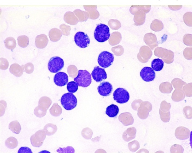 <p>FAB classification that refers to small blasts with a thin rim of cytoplasm:</p>