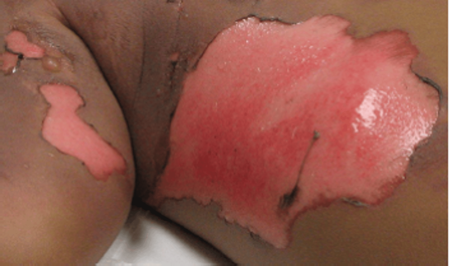 <p>They often appear as a blister or a raw, moist wound bed. Because they do not penetrate the entire dermis, they do not typically show subcutaneous fat or deeper structures.</p>