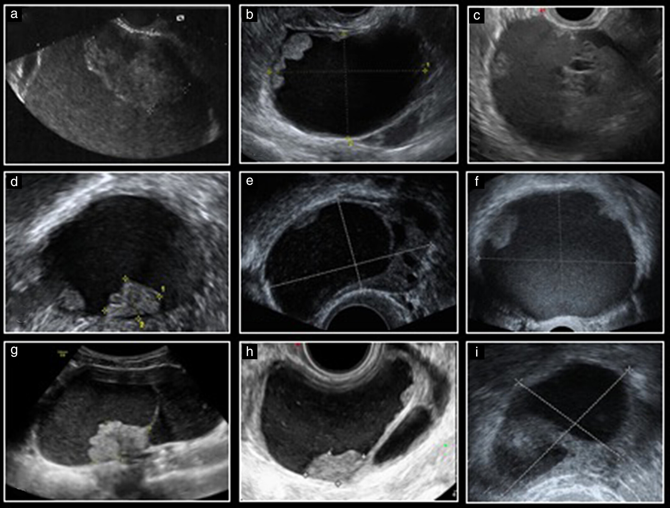 <p>2nd MC epithelial malignancy</p><p>1st MC is serous cystadenocarcinoma (also epithelial)  </p><ul><li><p>50 - 60 yrs</p></li></ul><p></p>