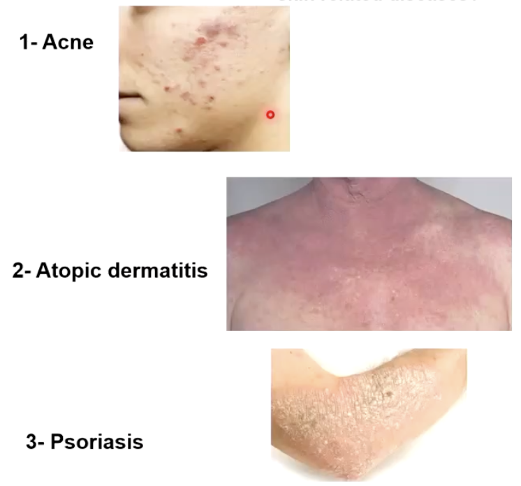 <ul><li><p>Potential treatments for:</p><ul><li><p>Acne</p></li><li><p>Atopic dermatitis</p></li><li><p>Psoriasis</p></li></ul></li><li><p>Example: Facial microbiota transplantation</p></li></ul><p></p>