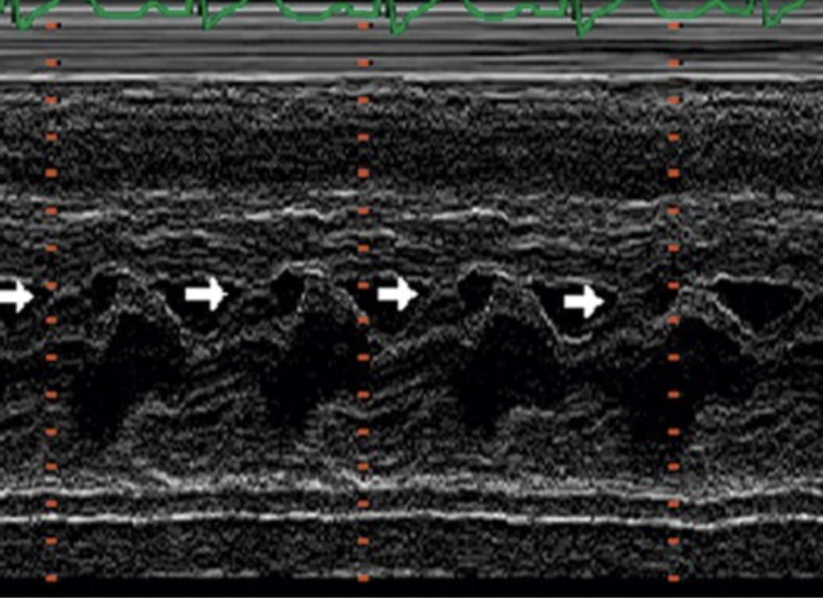 <p>systolic anterior motion of MV leaflets, reduced opening of MV leaflets in diastole</p>