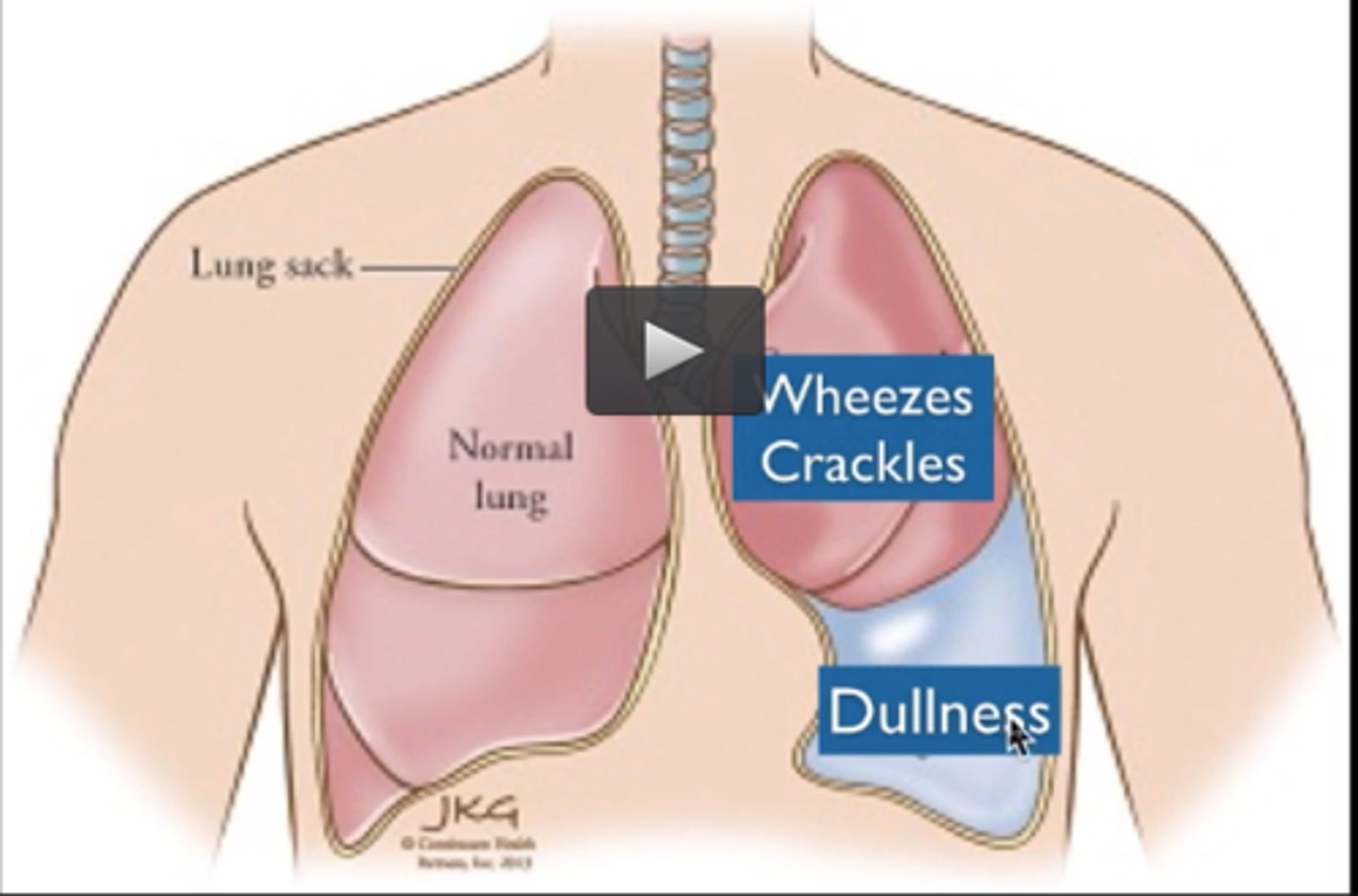 <p>abnormal accumulation of fluid in the pleural space</p>