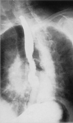 <p>What is this x-ray demonstrating?</p>
