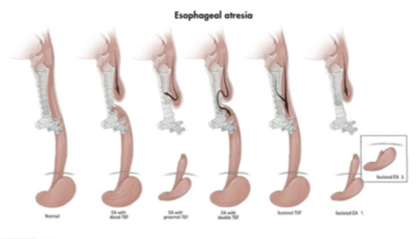 <p>congenital absence of part of the esophagus</p><p>- tx: foker procedure or colonic transplant</p>