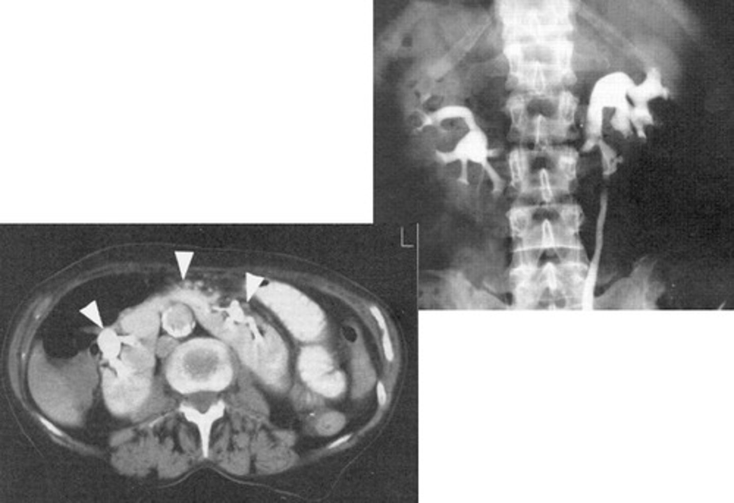 <p>- What congenital anomaly occurs when the lower poles of the kidney fail to separate in the fetus and results in a horseshoe-shaped kidney?</p><p>- What can patients frequently develop because the ureters are displaced with this pathology?</p>