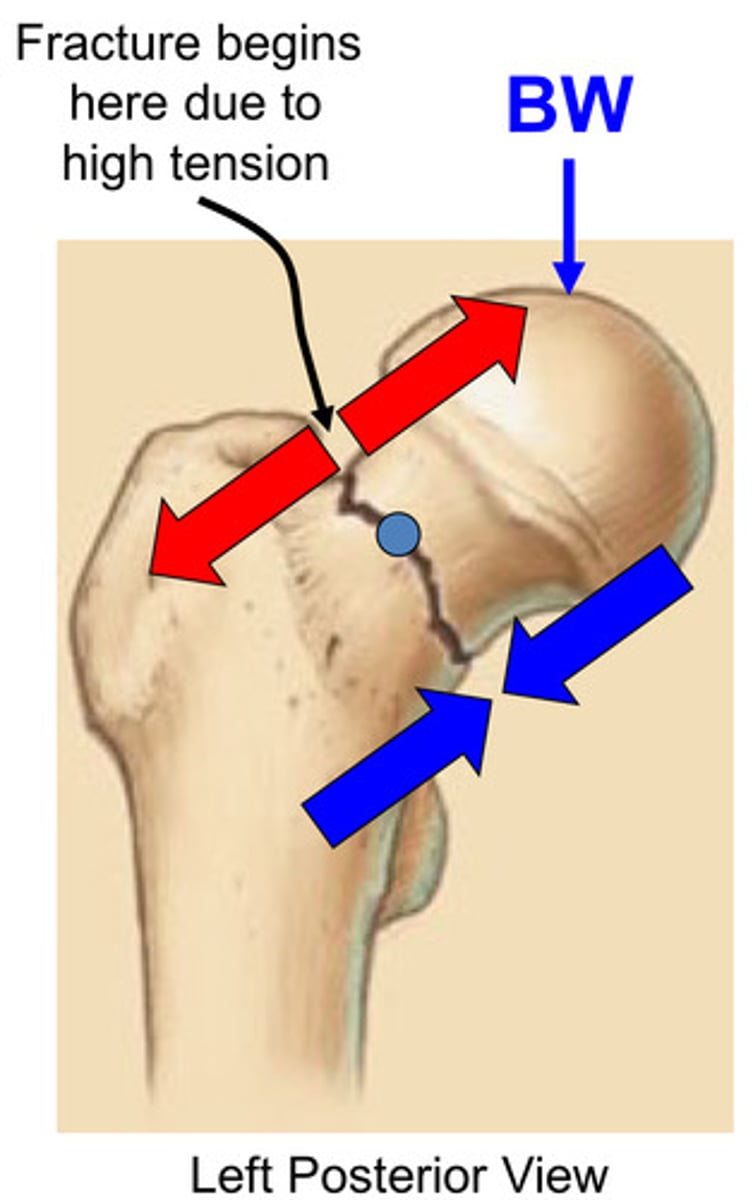 <p>result of bending loads in the body: common in the elderly due to decreased bone mineral density</p><p>common injury mechanism: unexpected load (e.g., stepping off a curb)</p>