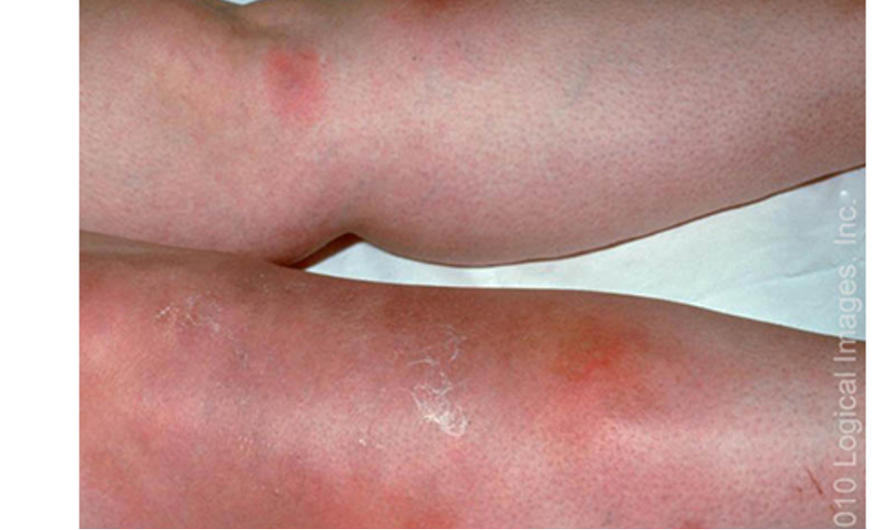 <p>delayed type hypersensitivity rxn that most often presents as erythematous, tender nodules on shins</p>
