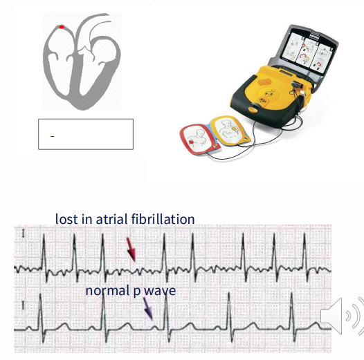 <p>- Cessation of normal cardiac electrical activity, heart stops pumping blood</p><p>CAUSES:</p><p>5-10% are due to arrhythmias</p><p>- note - not all arrhythmias will be rectified by defibrillation</p><p>.</p><p>10% are due to structural heart disease</p><p>- congenital coronary artery abnormalities</p><p>- myocarditis (inflammatory cardiomyopathy)</p><p>- hypertensive heart disease</p><p>- myocardial hypertrophy</p><p>.</p><p>15-20% are non-cardiac causes</p><p>- e.g trauma, aortic rupture, poison</p><p>.</p><p>65-70% - coronary heart disease (age 35+)</p>