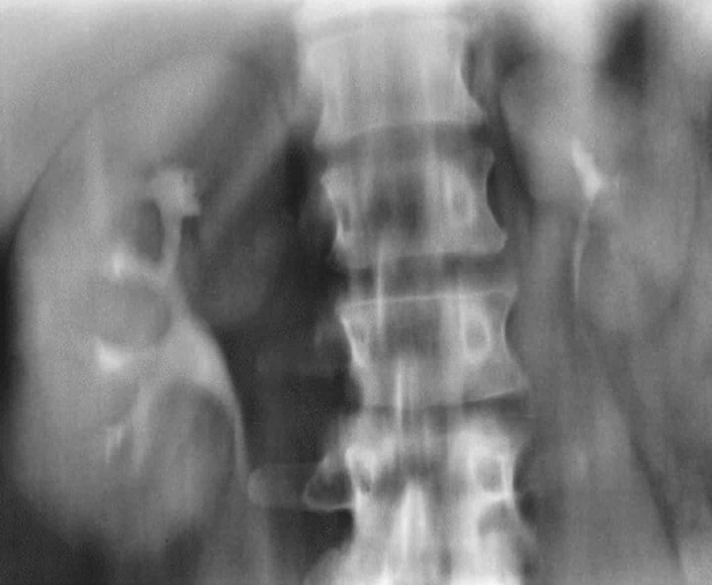 <p>- What congenital anomaly refers to an abnormally small kidney?</p><p>- How does the other kidney appear to compensate for the smaller kidney?</p>