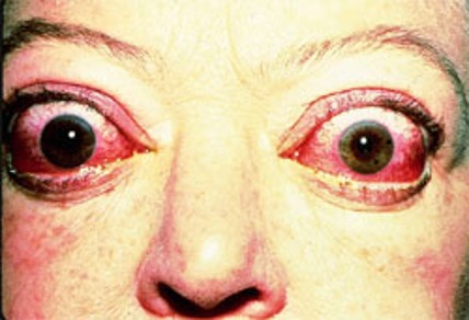 <ul><li><p><span><strong>Overactive thyroid gland</strong></span></p></li><li><p><span>Swelling of EOM</span></p></li><li><p><span>Proptosis - eye bulges out&nbsp;</span></p></li><li><p><span><strong>Inadequate globe coverage by eyelids = incomplete blink</strong></span></p></li></ul><p></p>