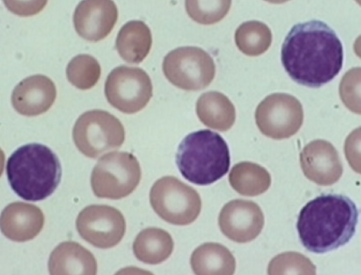 <p>What type of leukemia is this? Acute or Chronic</p>