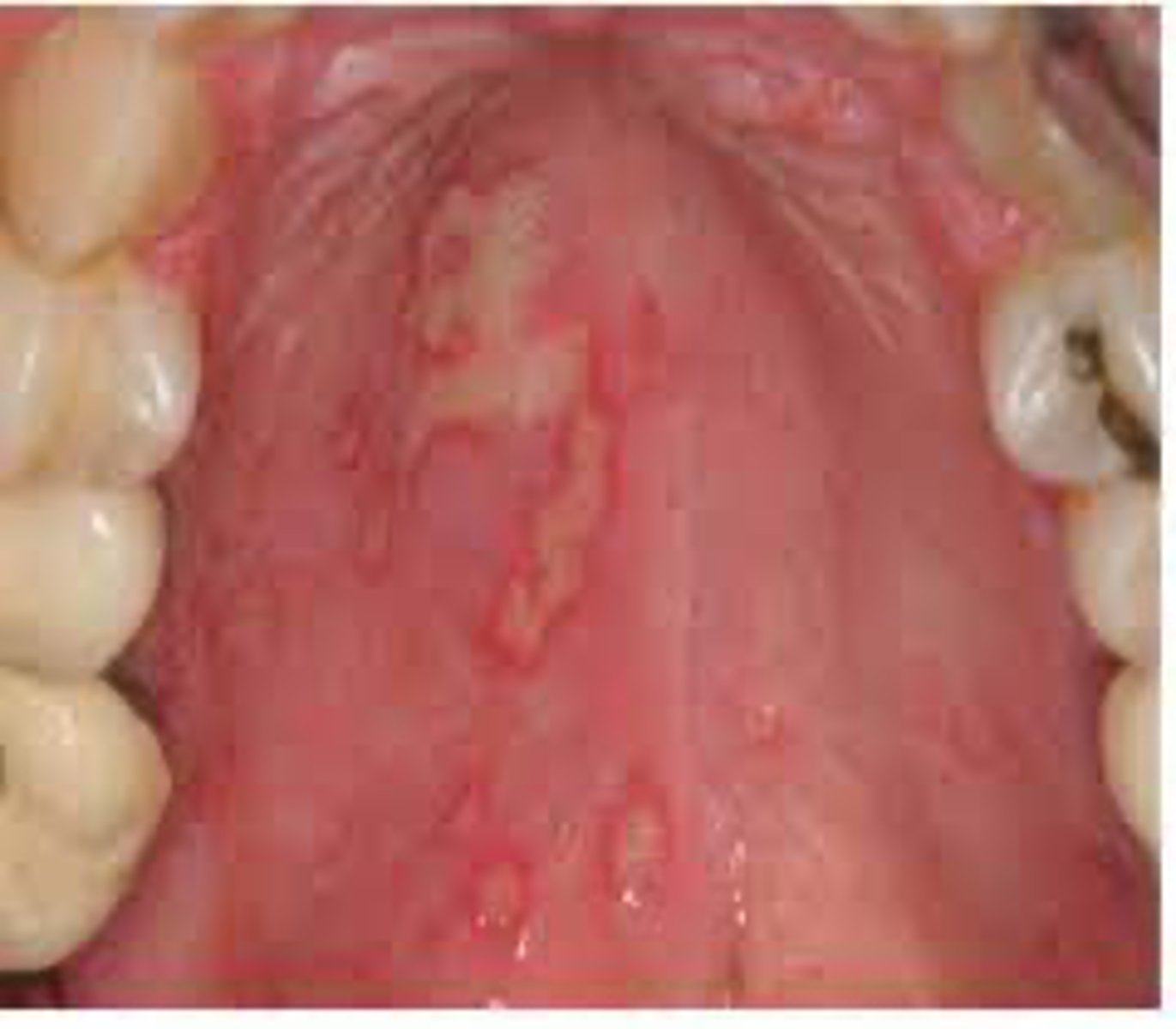 <p>a patient presents with these lesions on their palate. what condition does the patient have?</p>