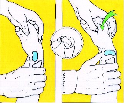 <ul><li><p><strong>scaphoid instability </strong></p></li><li><p>attempt to translate scaphoid anteriorly and posteriorly </p></li><li><p>positive = dislocation/subluxation </p></li></ul><p></p>