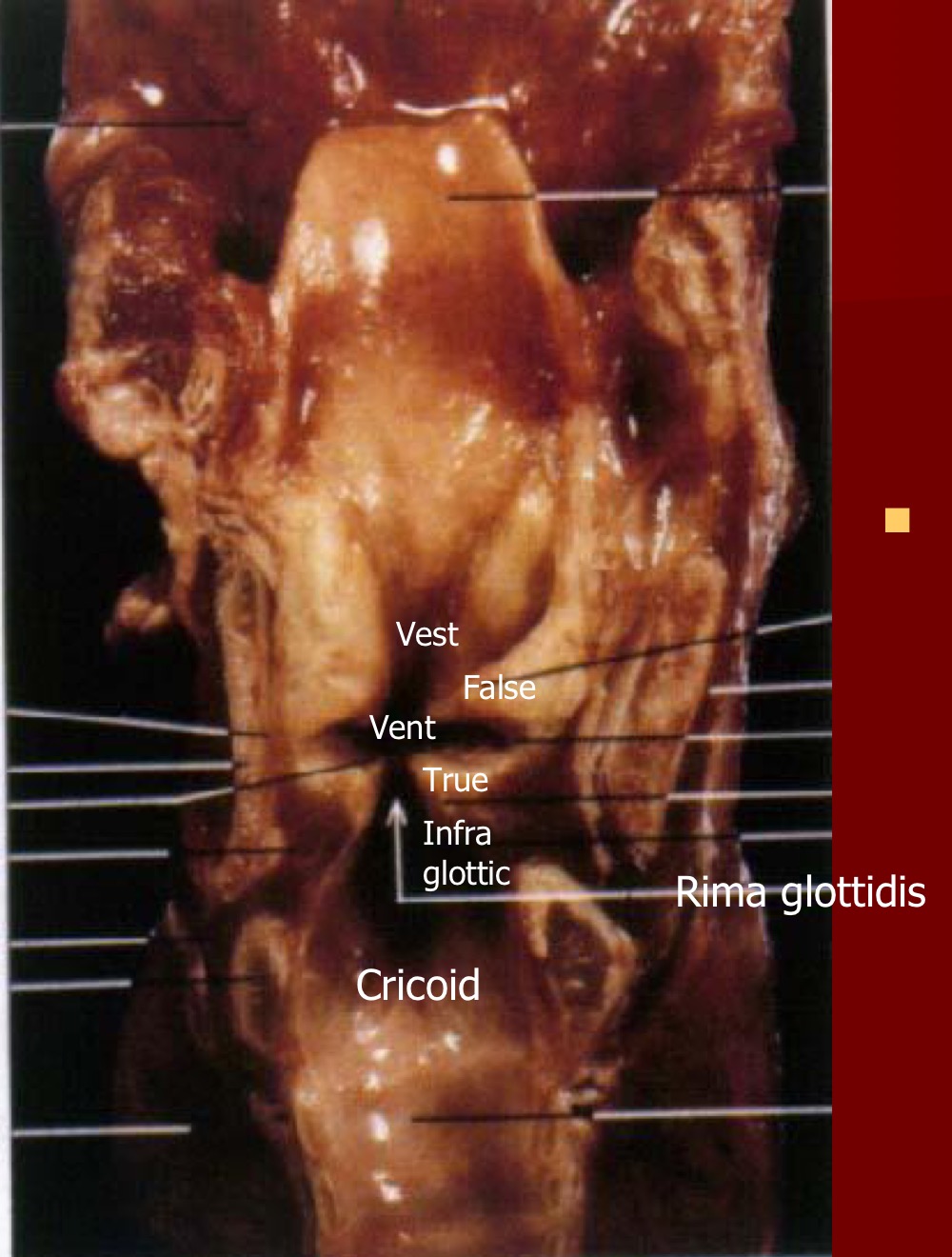 aperture between vocal folds