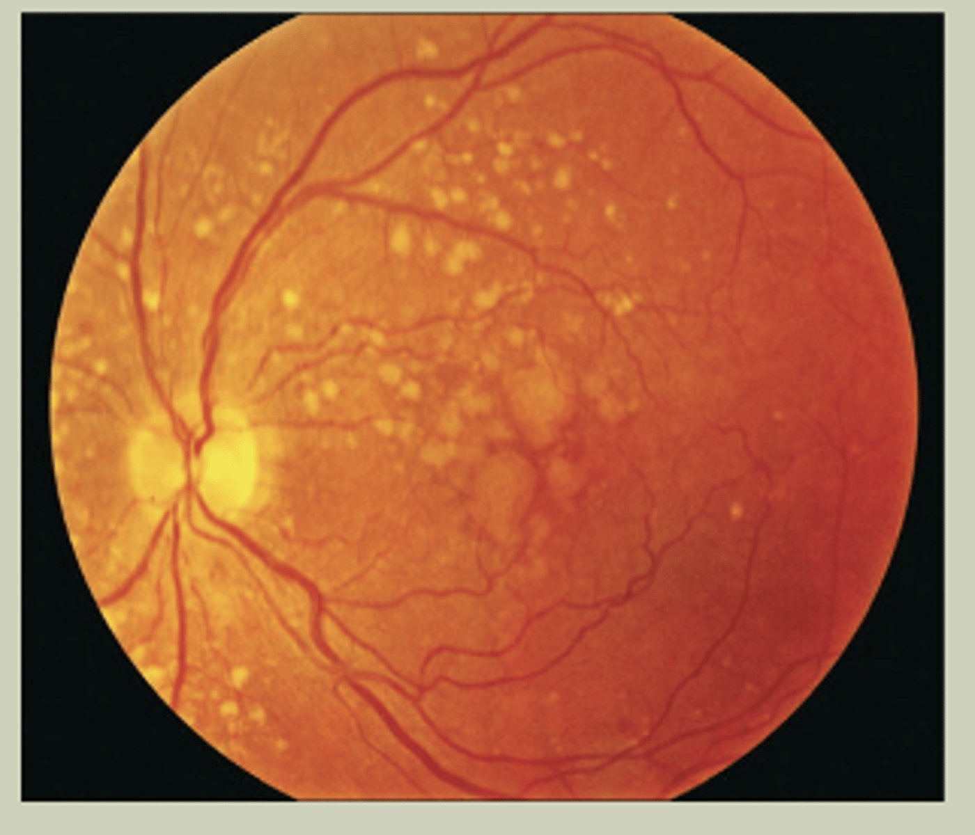 <p>-Gradual change to vision bilaterally</p><p>-Wavy vision or central missing spot in vision</p><p>-May see drusen in macular region with DO</p><p>-TX: URGENT referral to ECP</p>