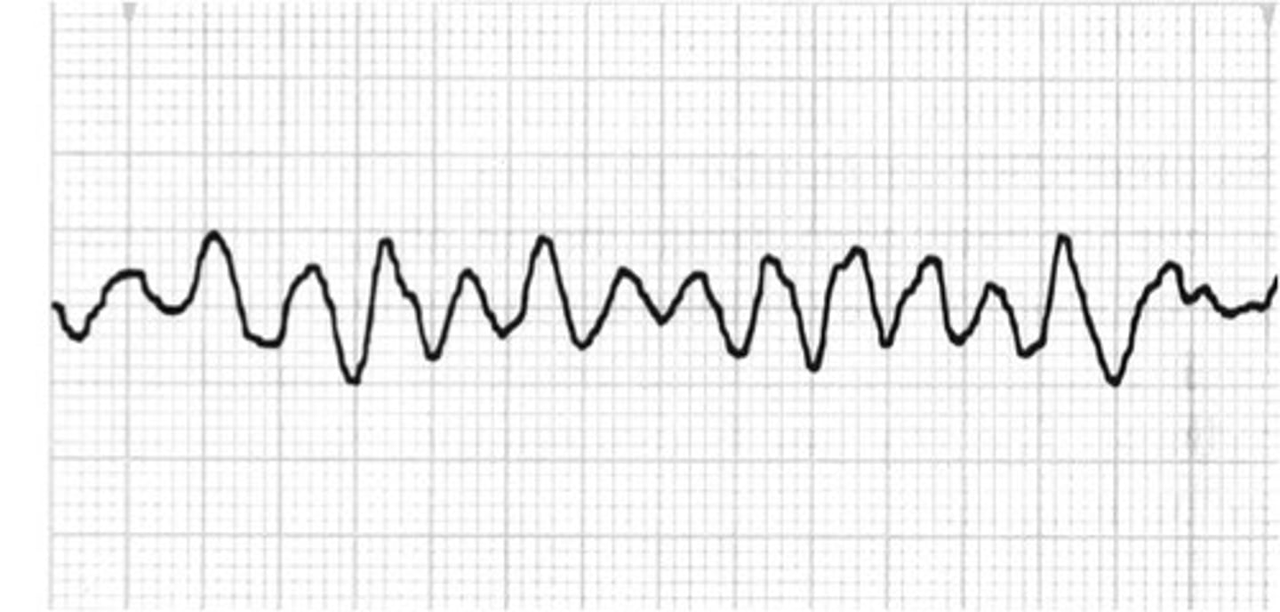 <p>cardiac arrest, CPR and defibrillation, lack of identifiable waves</p>