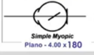 <p>simple myopic astigmatism</p>